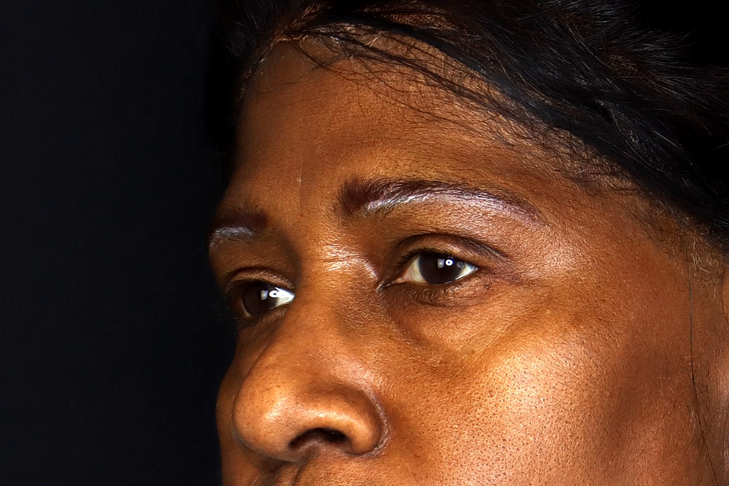 Blepharoplasty | Eyelid Lift Before & After