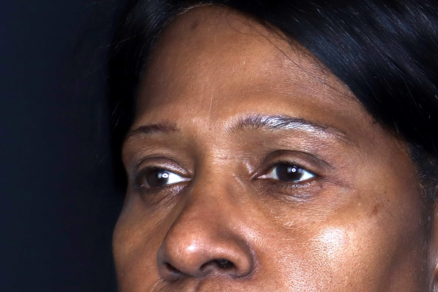 Blepharoplasty | Eyelid Lift Before & After