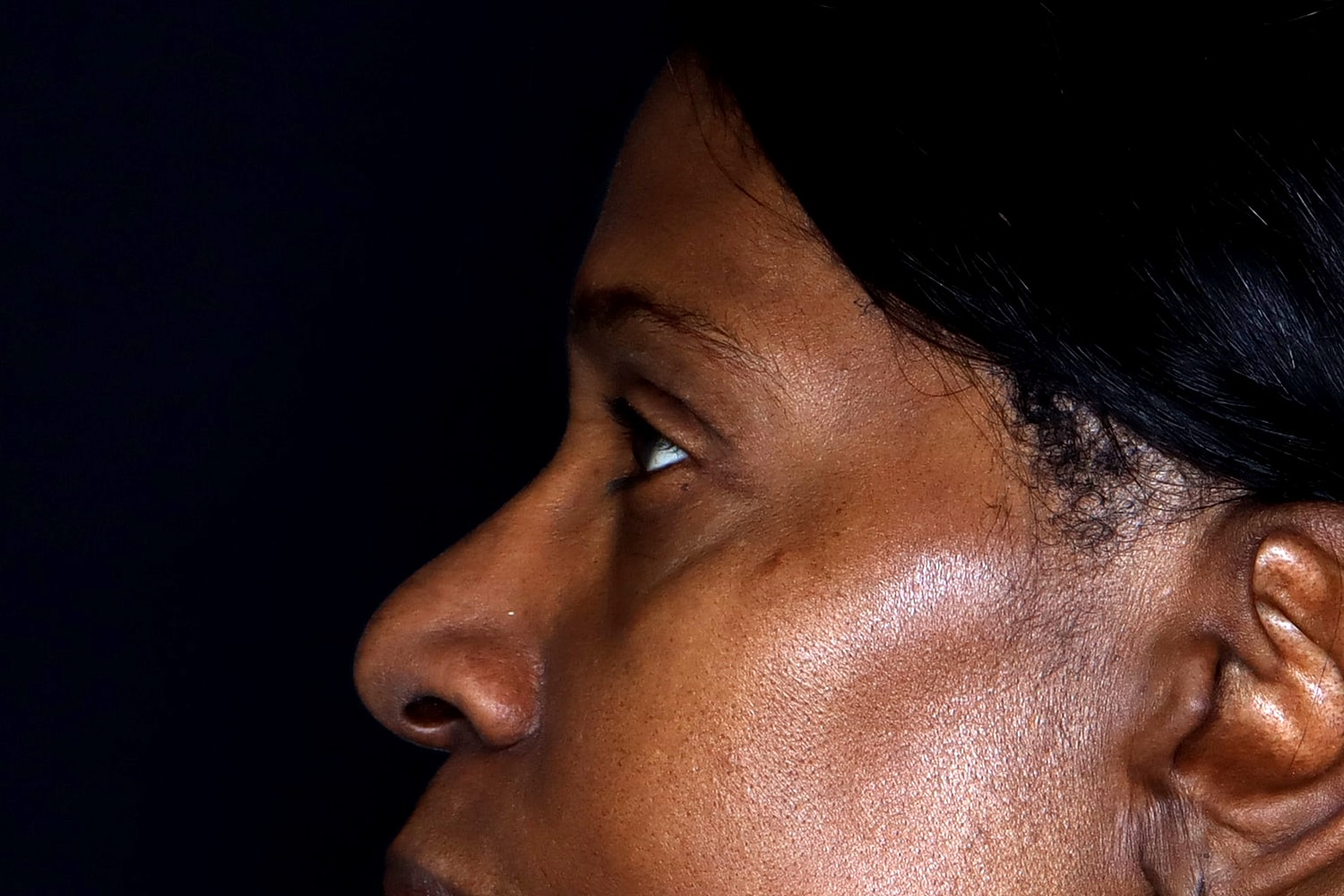Blepharoplasty | Eyelid Lift Before & After