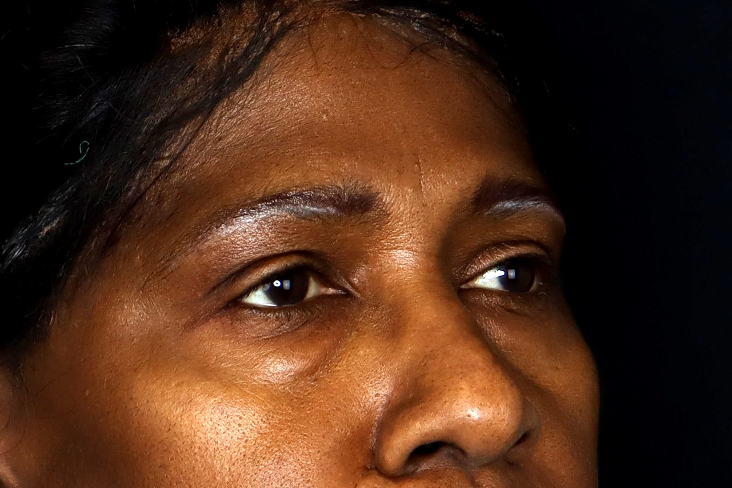 Blepharoplasty | Eyelid Lift Before & After