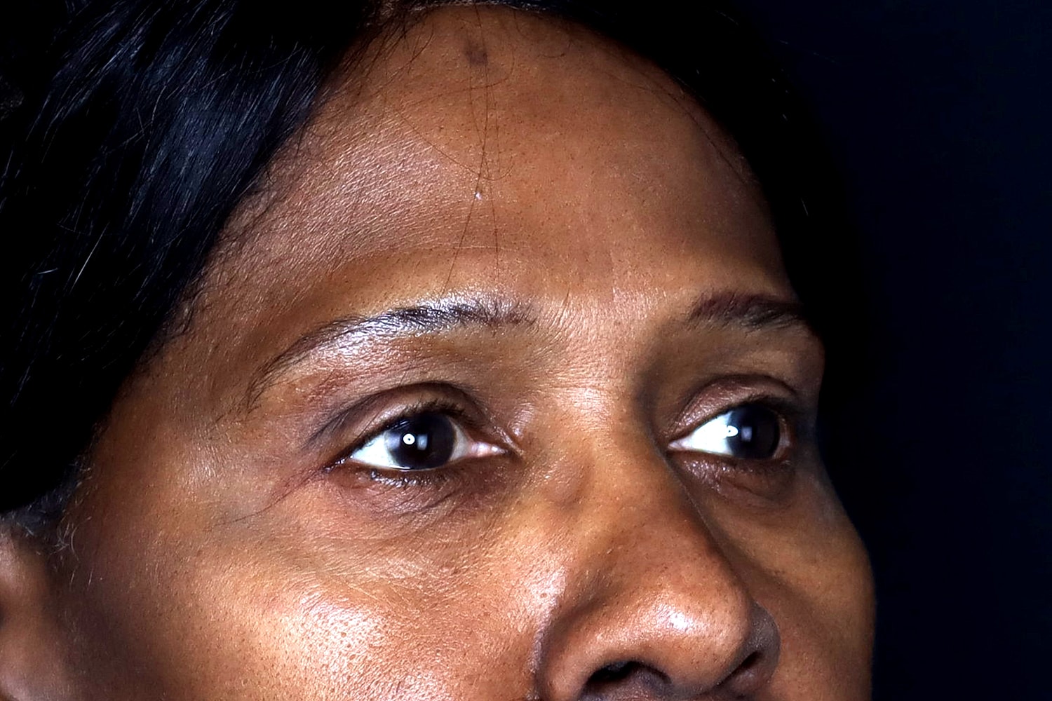 Blepharoplasty | Eyelid Lift Before & After