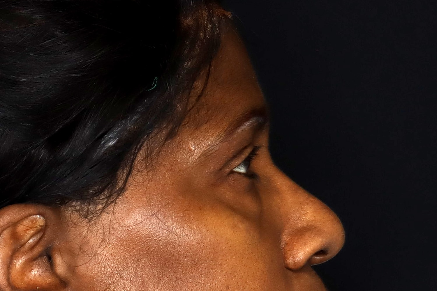 Blepharoplasty | Eyelid Lift Before & After