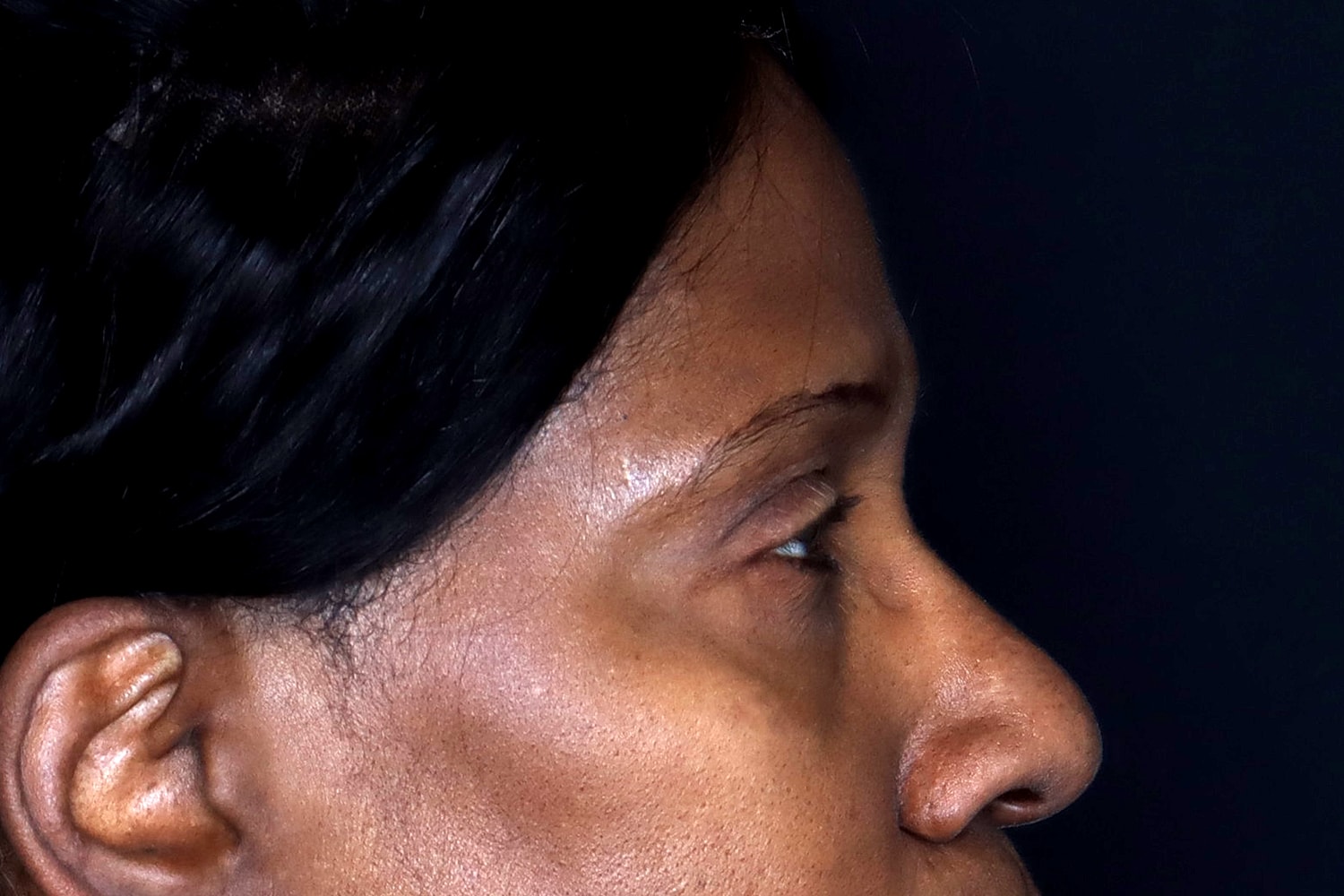 Blepharoplasty | Eyelid Lift Before & After