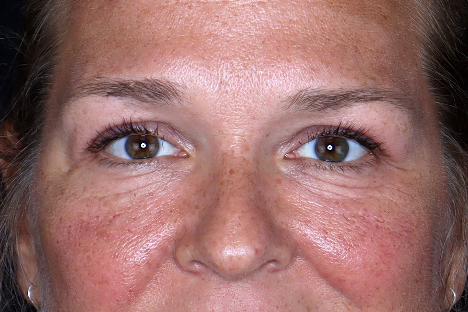 Blepharoplasty | Eyelid Lift Before & After