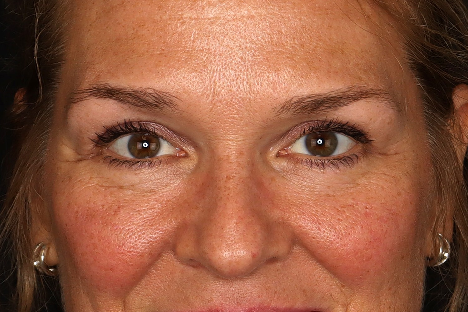 Blepharoplasty | Eyelid Lift Before & After