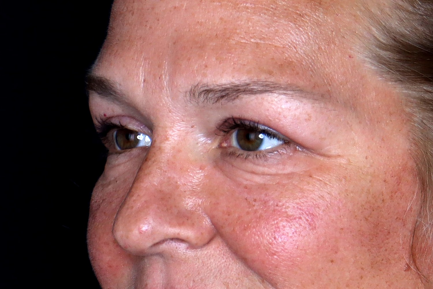Blepharoplasty | Eyelid Lift Before & After