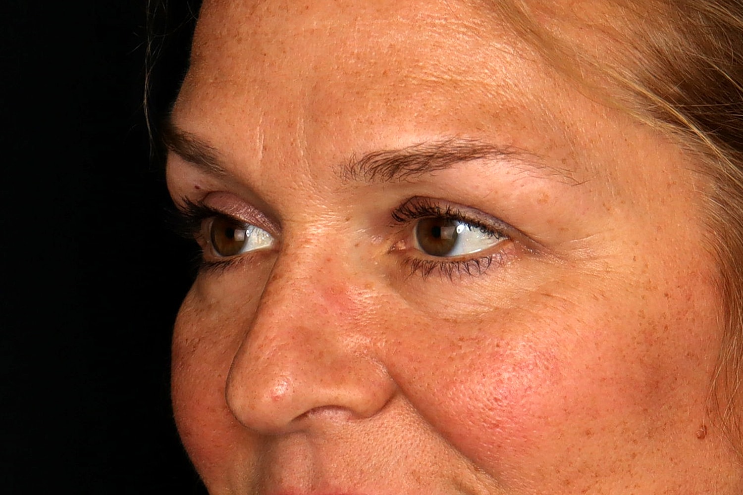 Blepharoplasty | Eyelid Lift Before & After