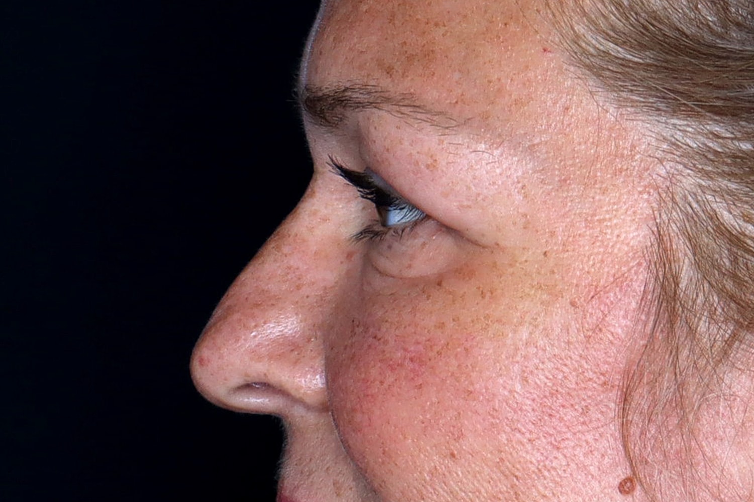 Blepharoplasty | Eyelid Lift Before & After
