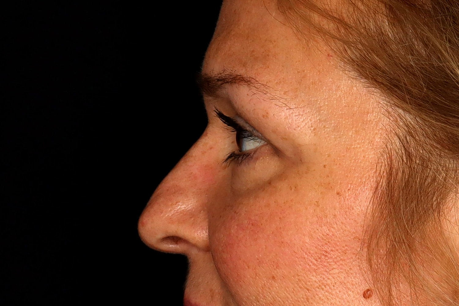 Blepharoplasty | Eyelid Lift Before & After