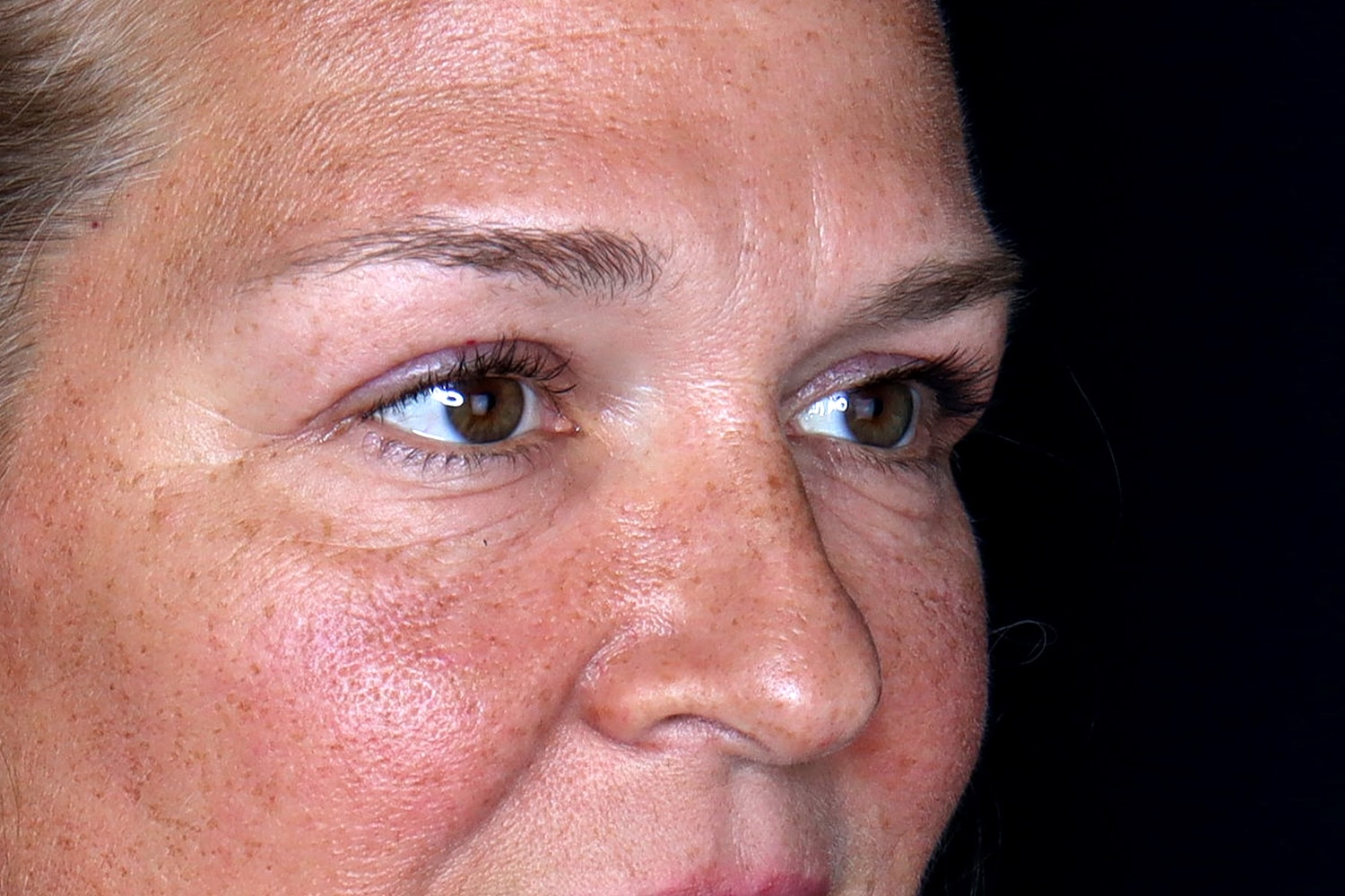 Blepharoplasty | Eyelid Lift Before & After