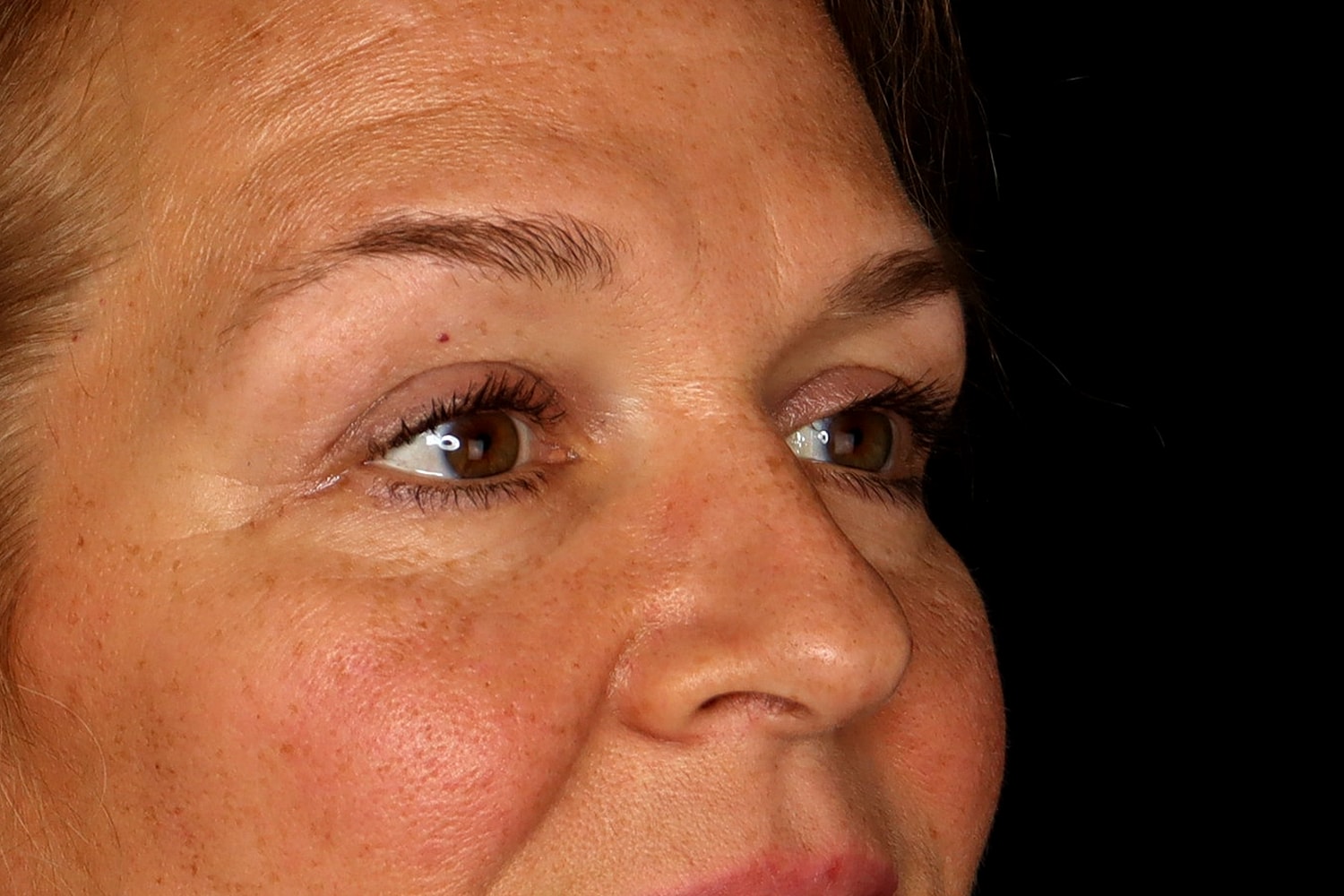Blepharoplasty | Eyelid Lift Before & After