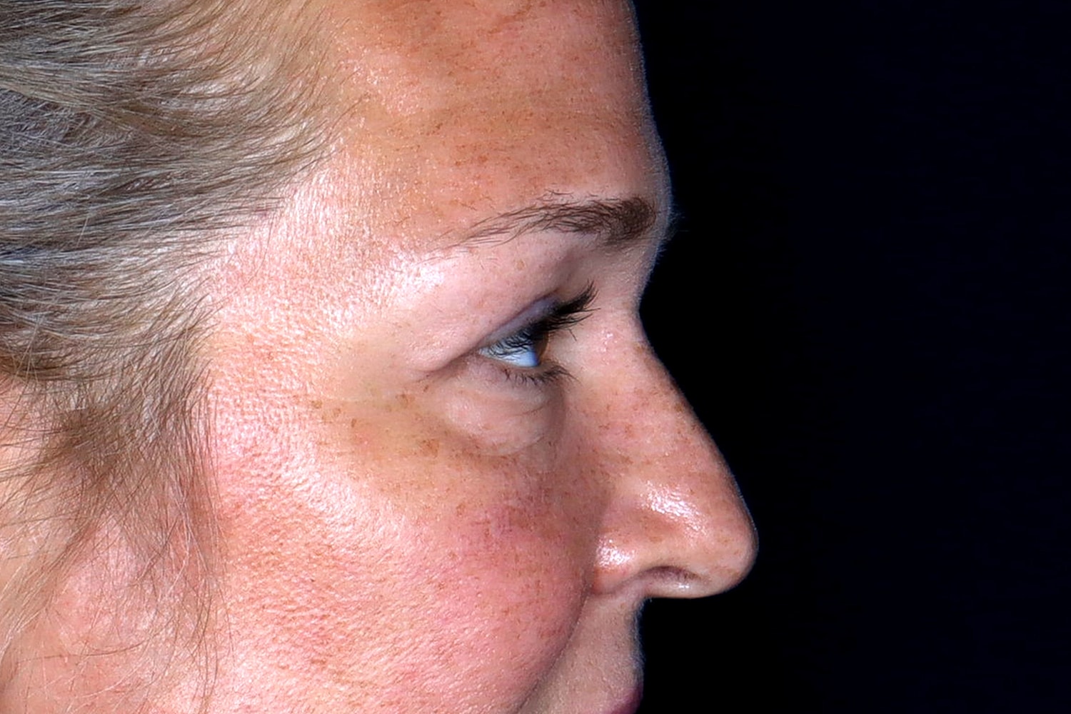 Blepharoplasty | Eyelid Lift Before & After