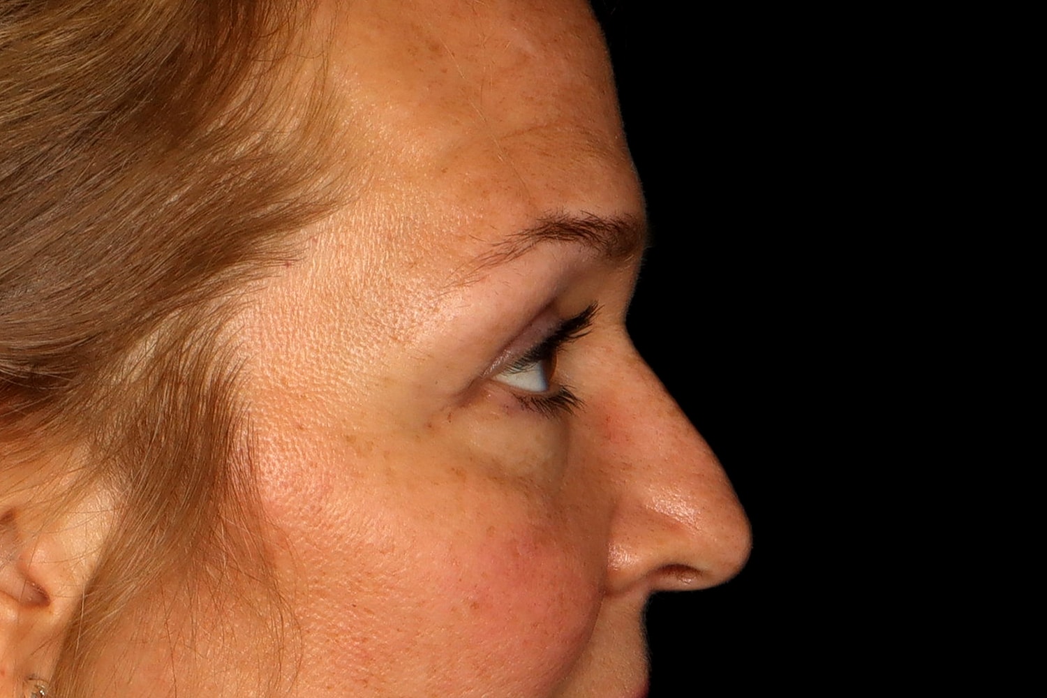 Blepharoplasty | Eyelid Lift Before & After