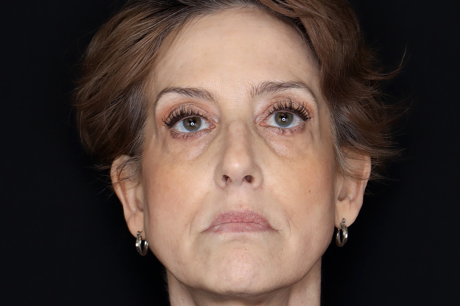 Blepharoplasty | Eyelid Lift Before & After
