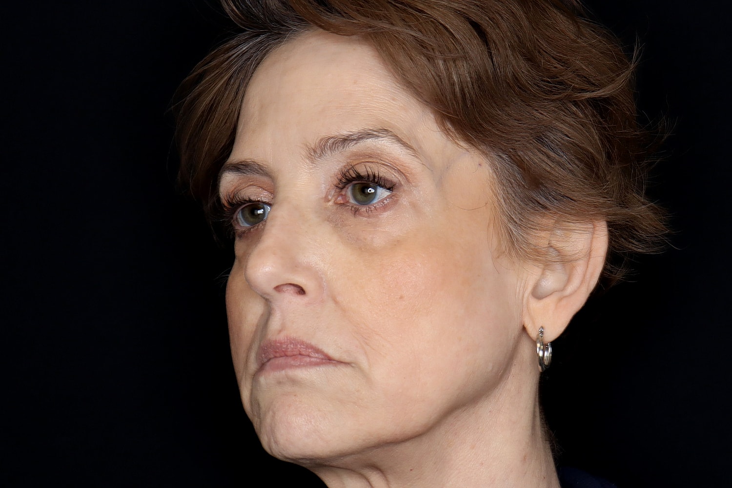 Blepharoplasty | Eyelid Lift Before & After