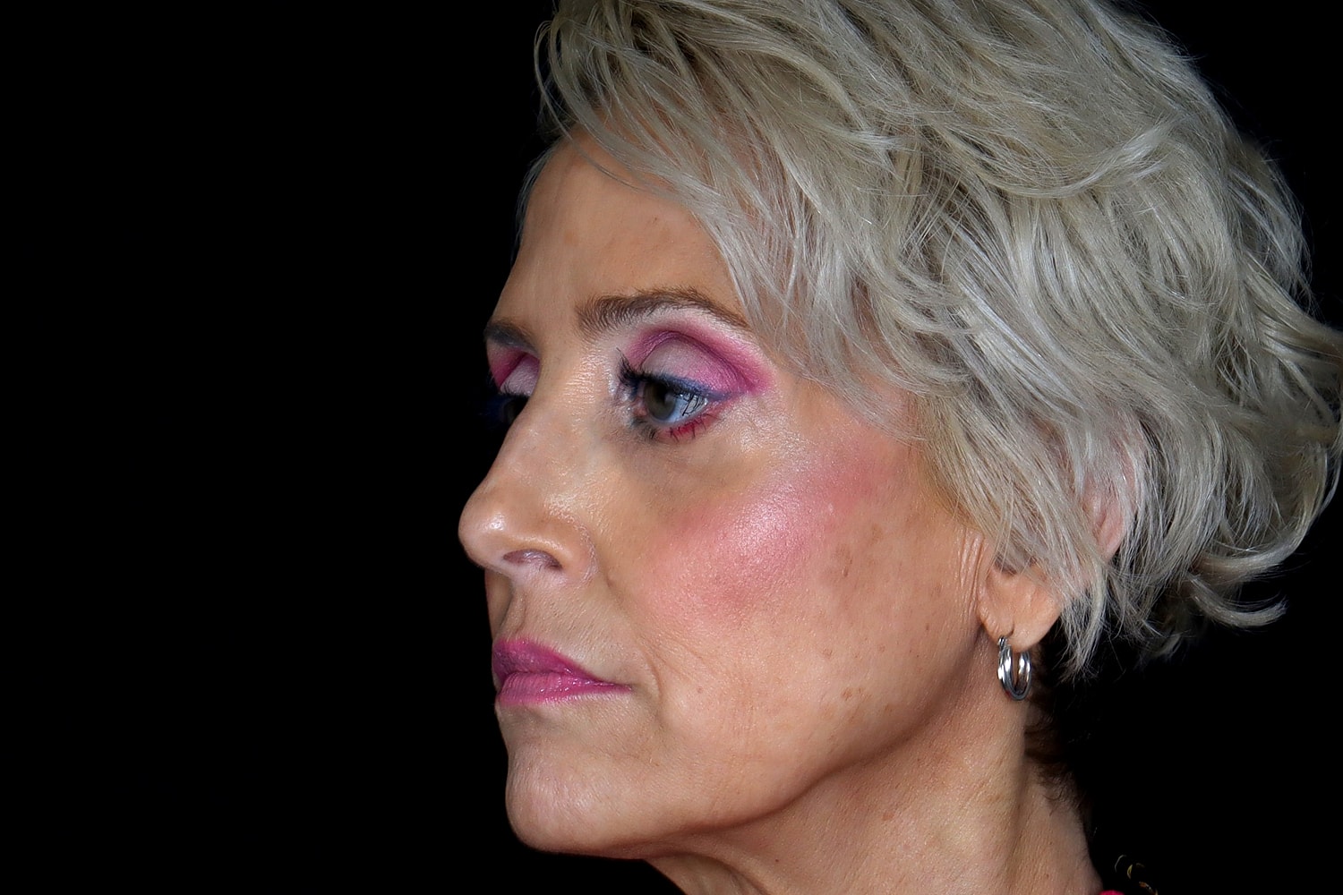 Blepharoplasty | Eyelid Lift Before & After