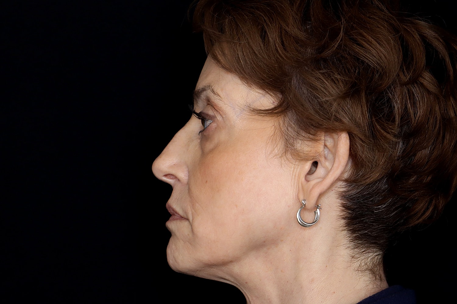 Blepharoplasty | Eyelid Lift Before & After