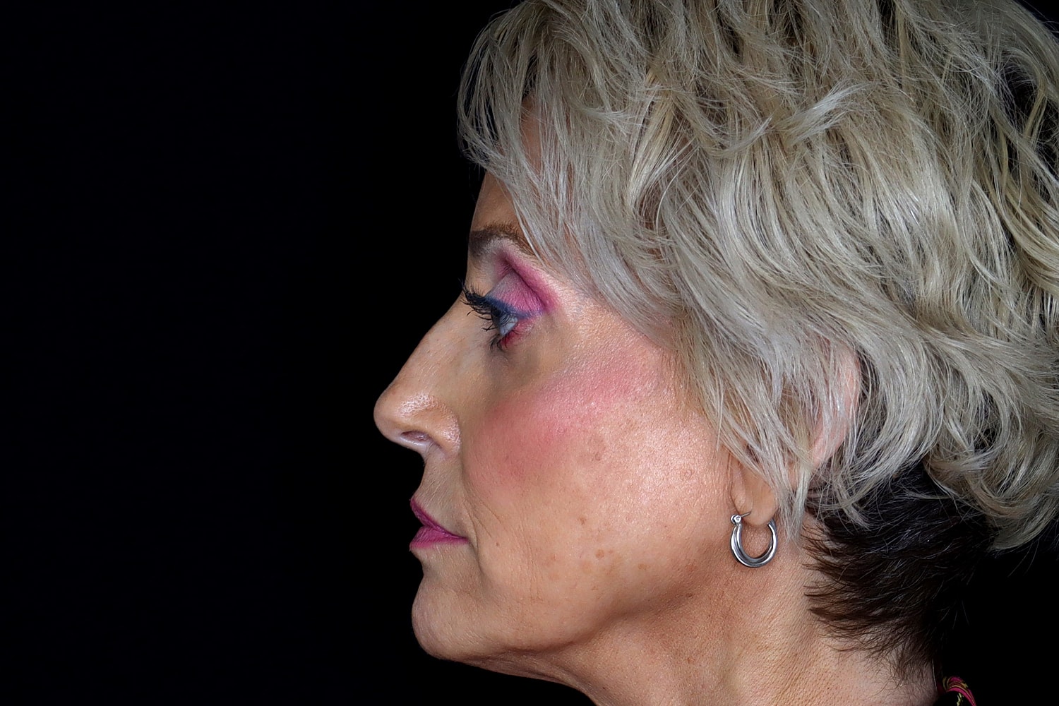 Blepharoplasty | Eyelid Lift Before & After