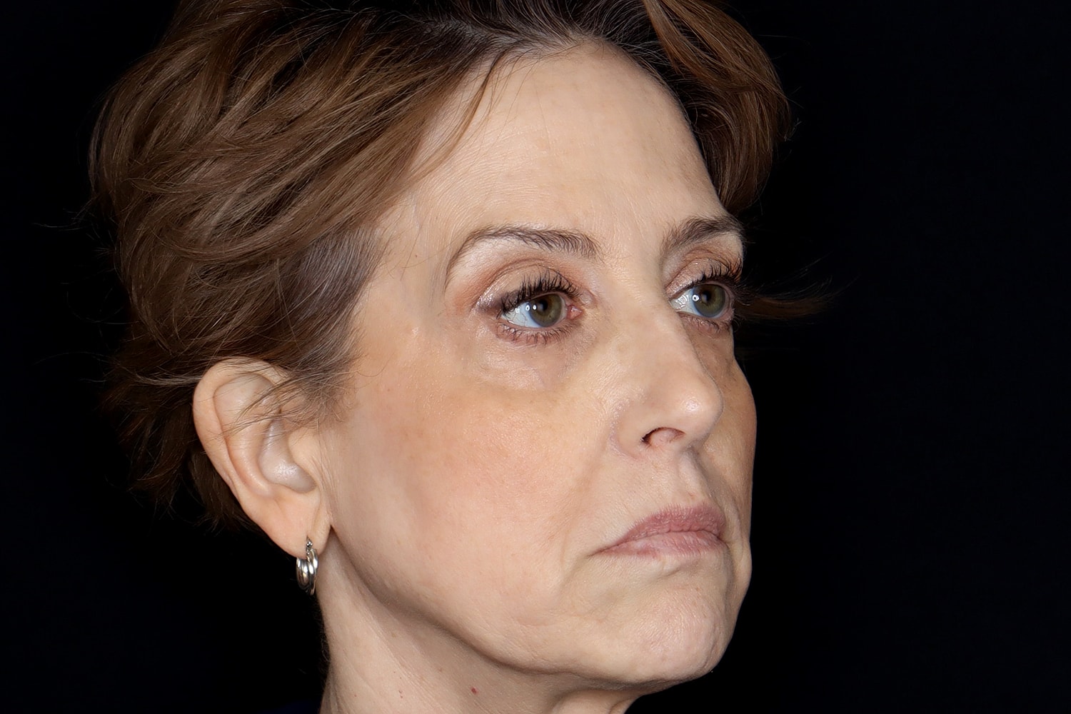 Blepharoplasty | Eyelid Lift Before & After