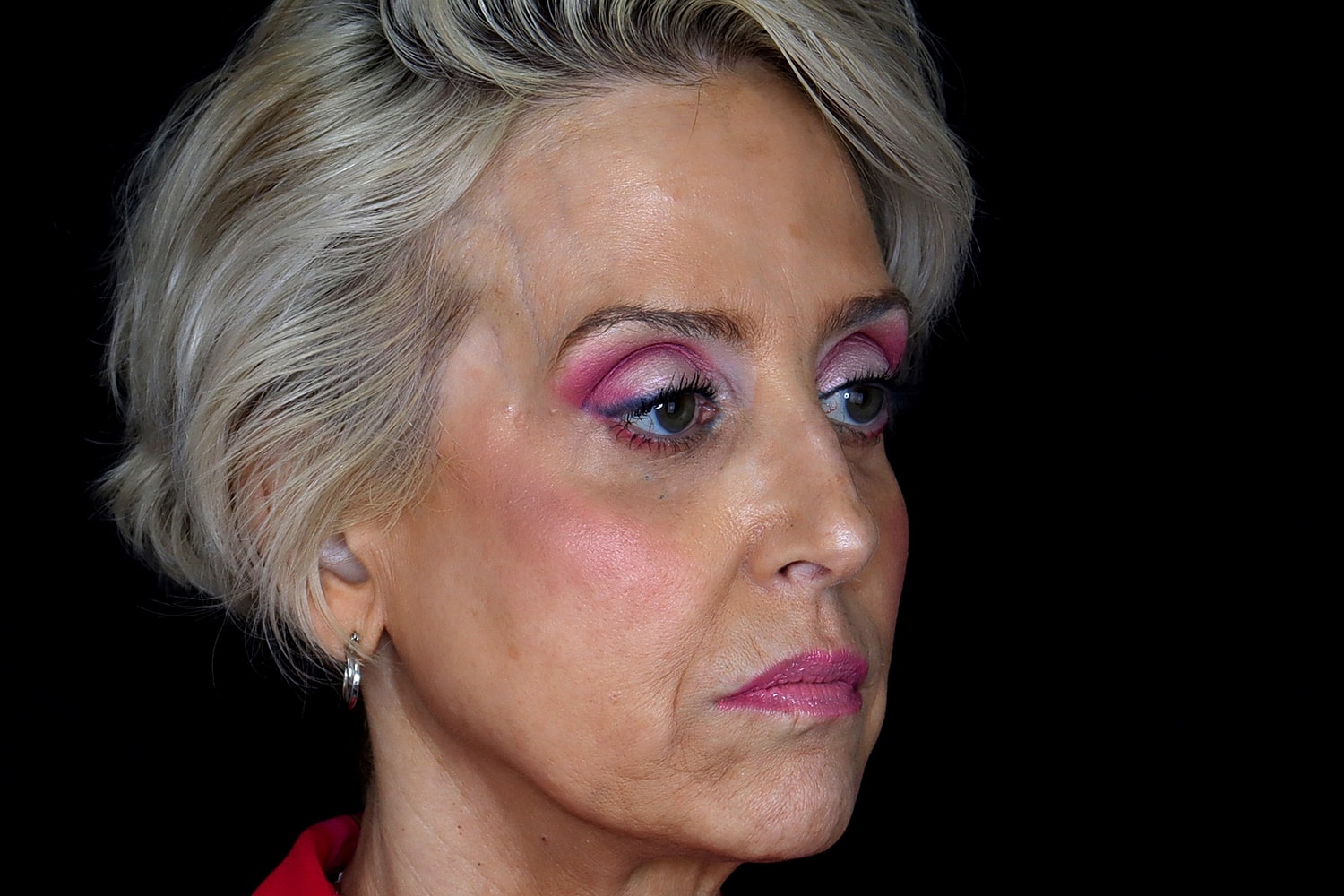 Blepharoplasty | Eyelid Lift Before & After