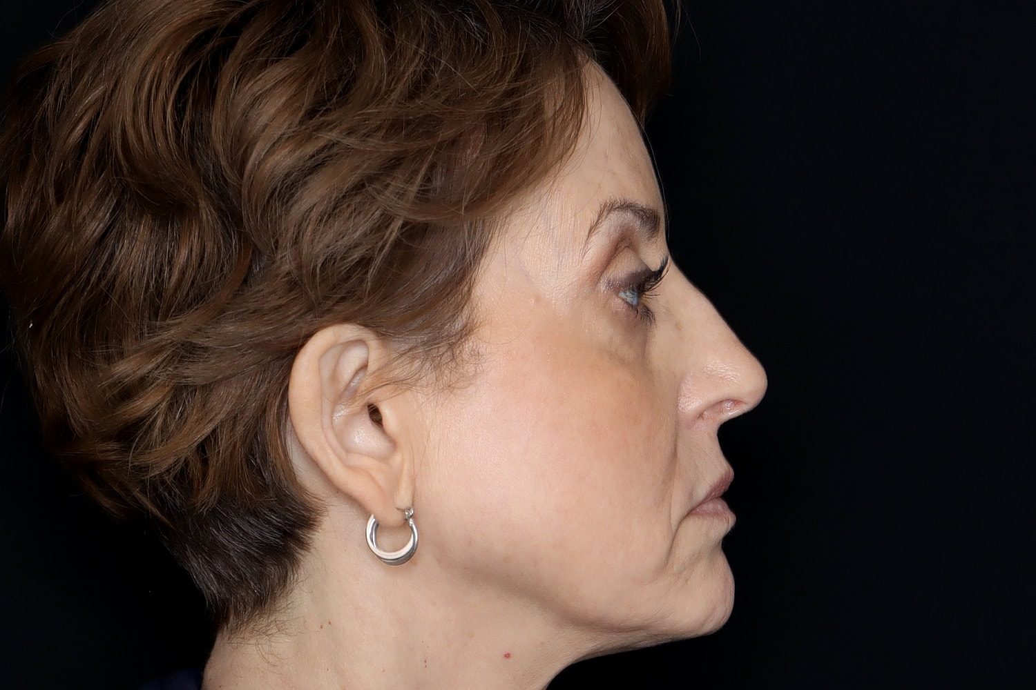 Blepharoplasty | Eyelid Lift Before & After