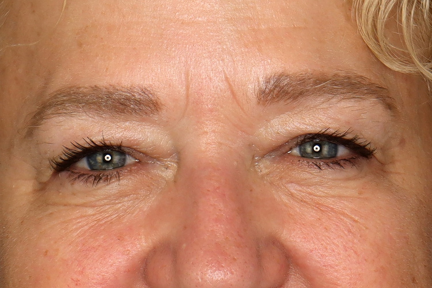 Blepharoplasty | Eyelid Lift Before & After