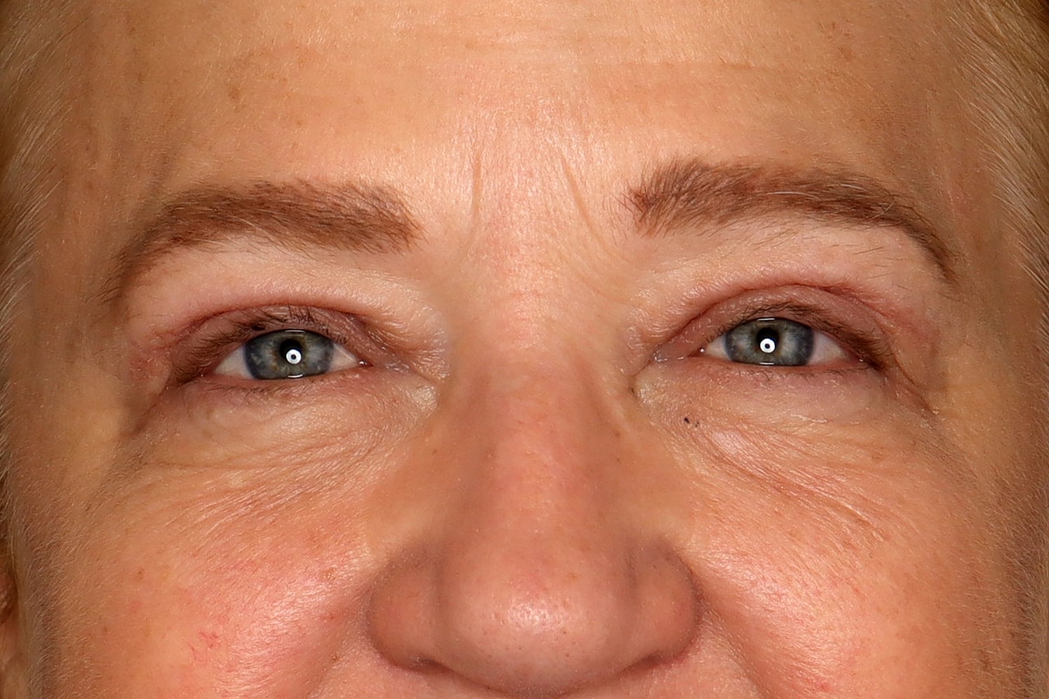 Blepharoplasty | Eyelid Lift Before & After