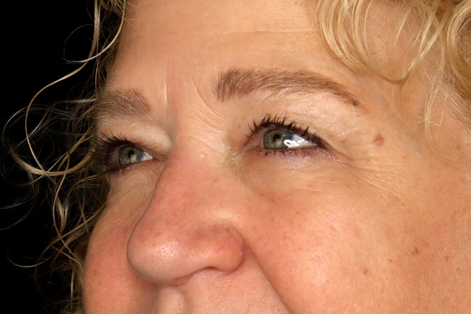 Blepharoplasty | Eyelid Lift Before & After