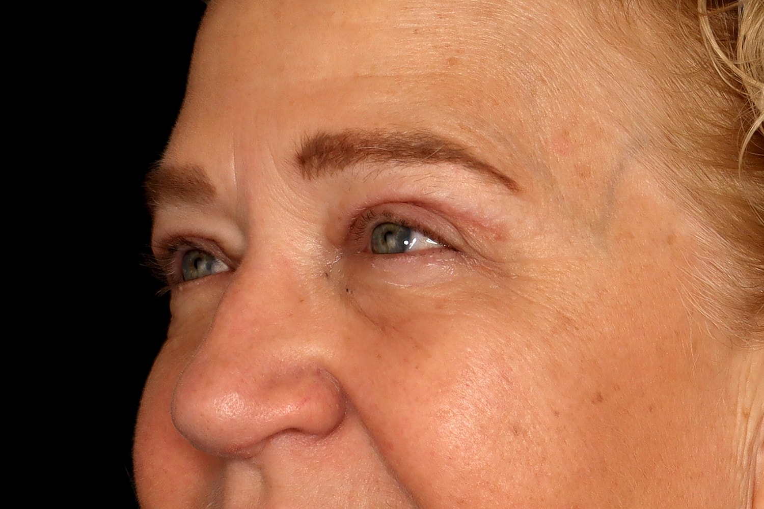 Blepharoplasty | Eyelid Lift Before & After