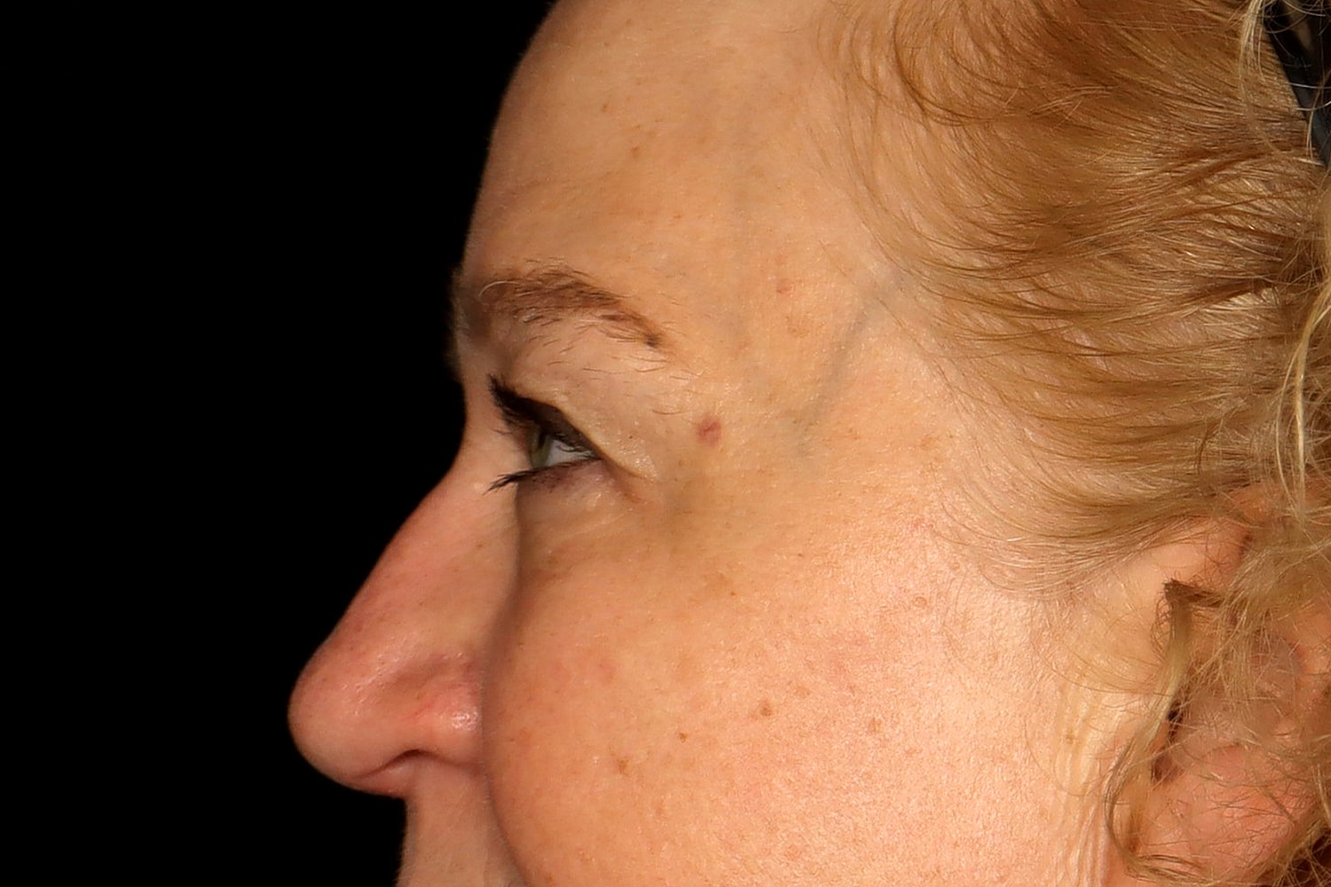 Blepharoplasty | Eyelid Lift Before & After