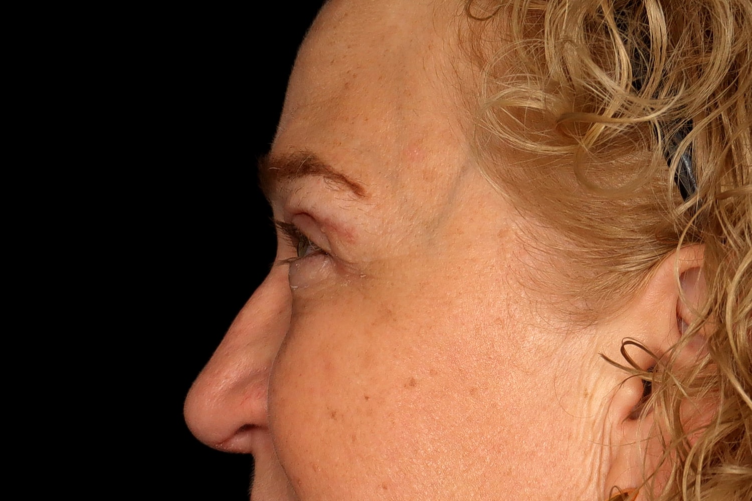 Blepharoplasty | Eyelid Lift Before & After