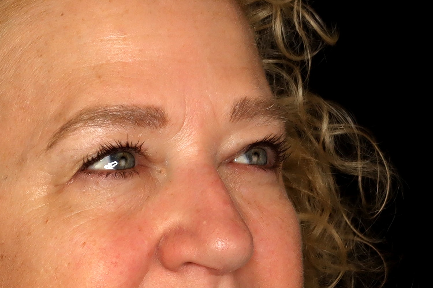 Blepharoplasty | Eyelid Lift Before & After