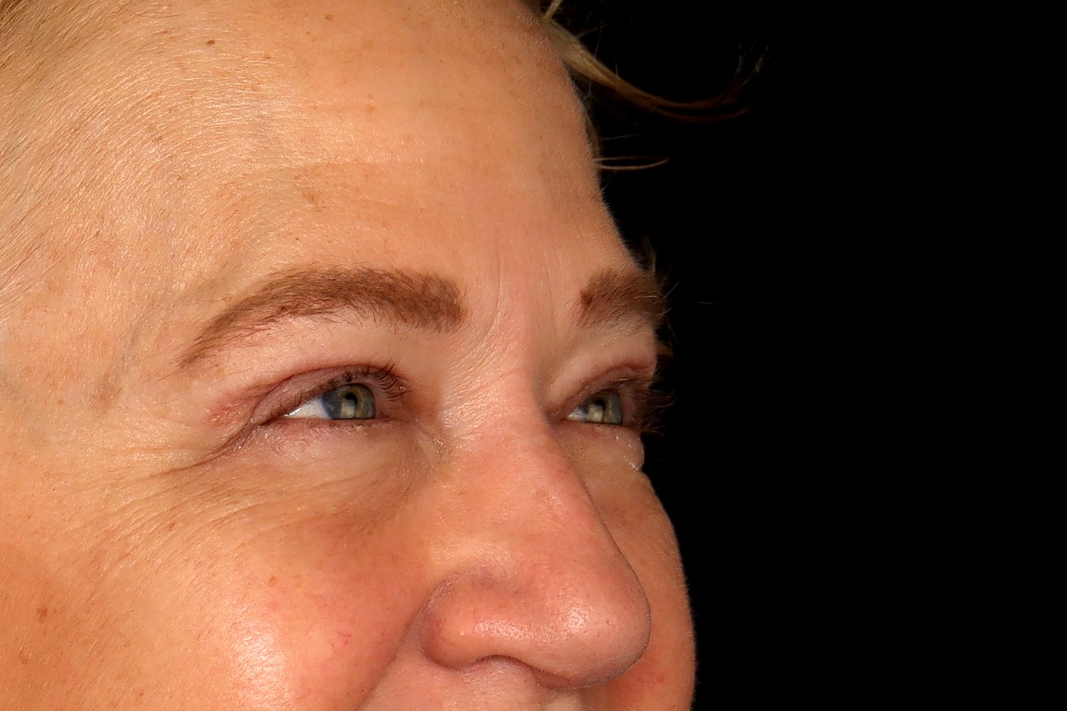 Blepharoplasty | Eyelid Lift Before & After