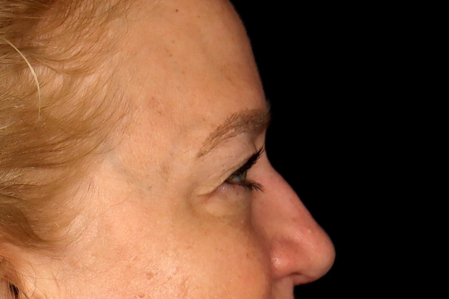 Blepharoplasty | Eyelid Lift Before & After