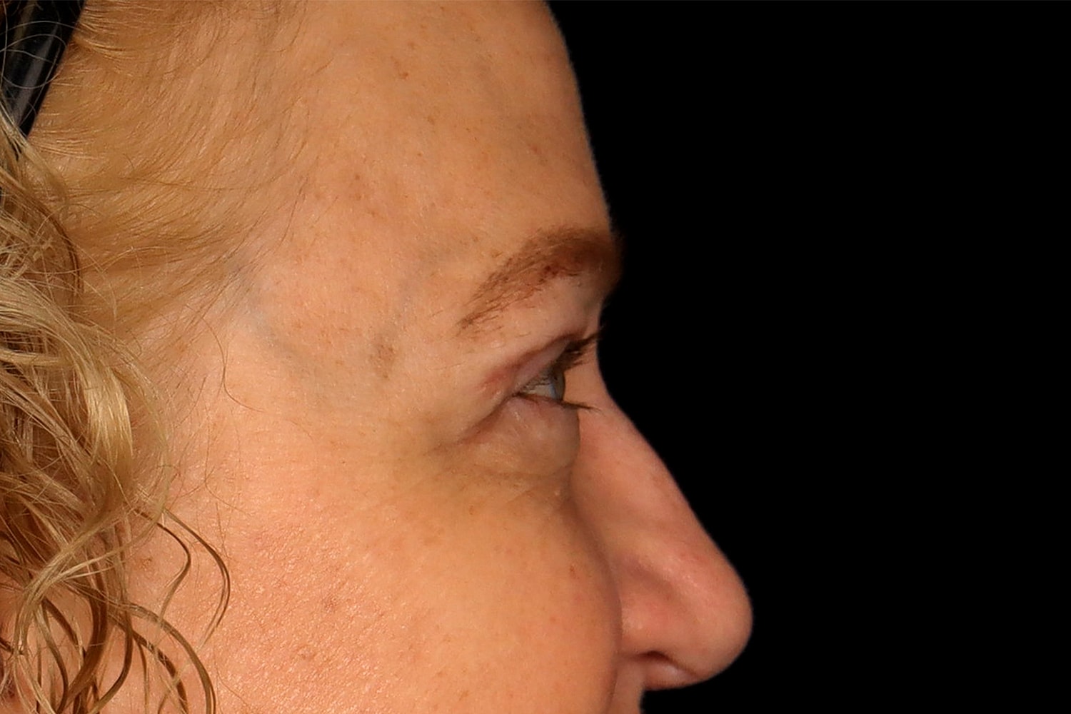 Blepharoplasty | Eyelid Lift Before & After
