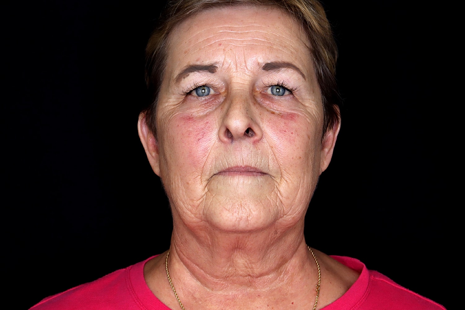 Blepharoplasty | Eyelid Lift Before & After