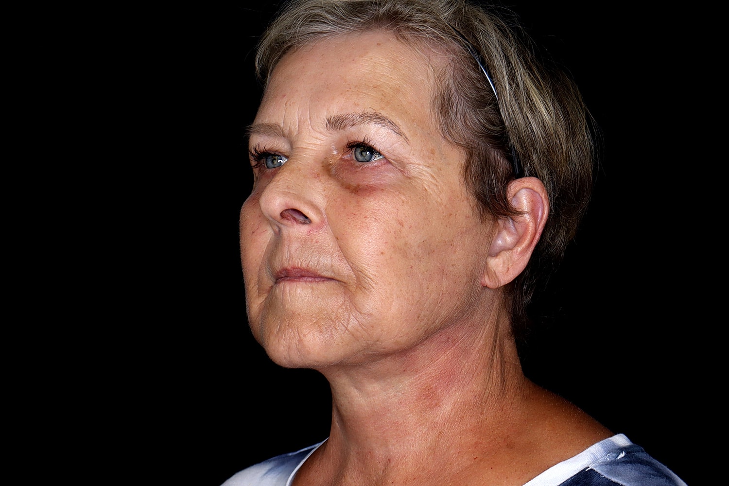 Blepharoplasty | Eyelid Lift Before & After