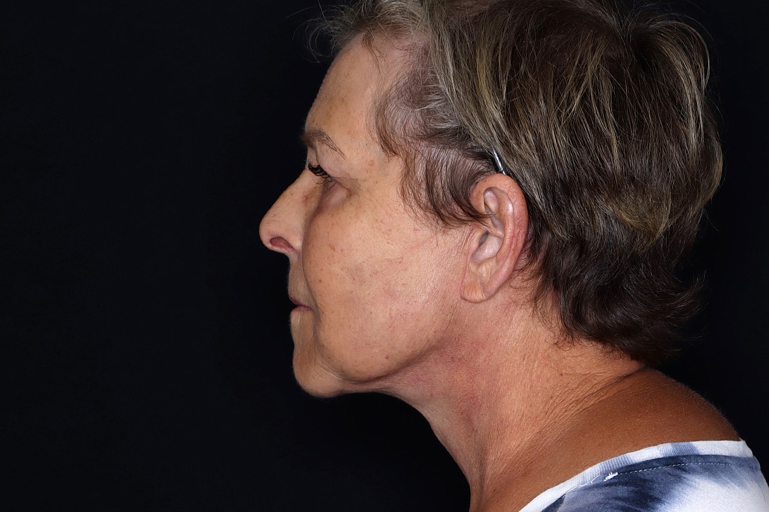 Blepharoplasty | Eyelid Lift Before & After