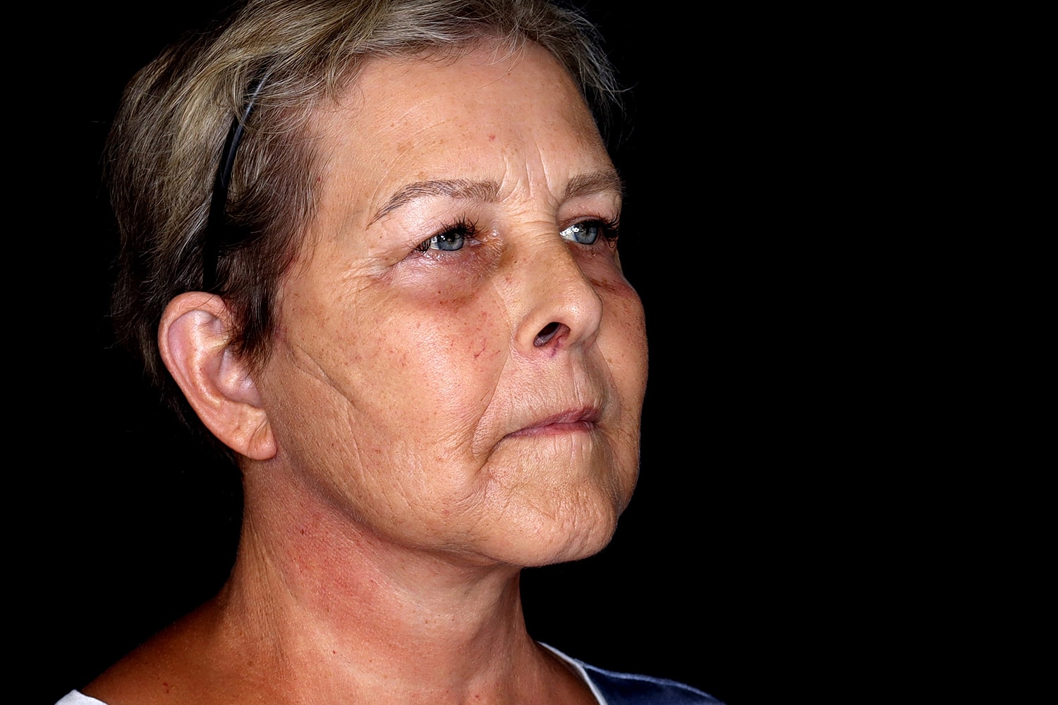 Blepharoplasty | Eyelid Lift Before & After
