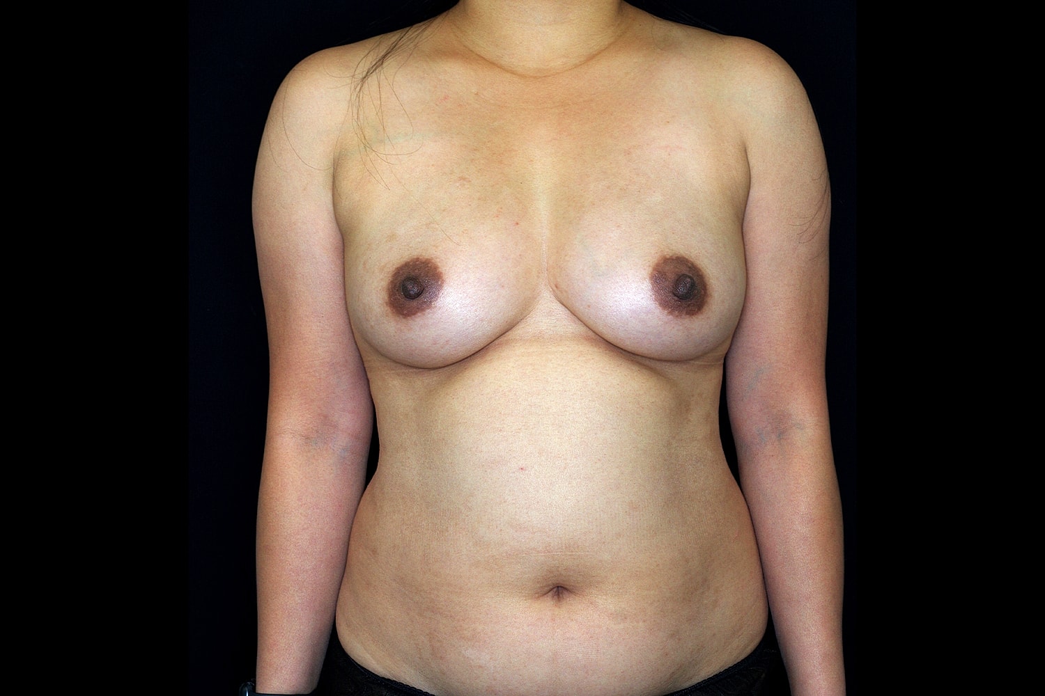 Fat Transfer To Breasts Before & After