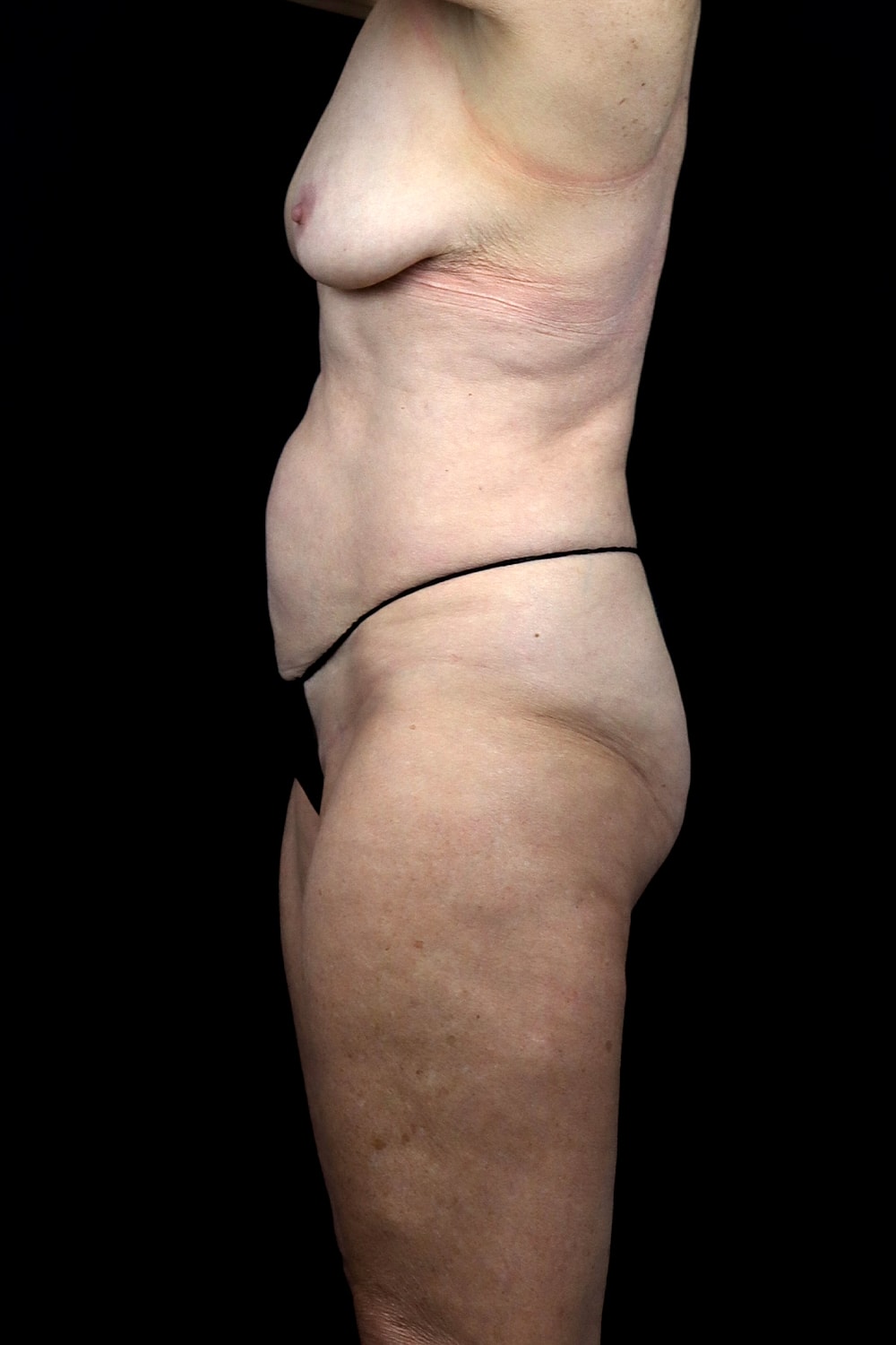 Fat Transfer To Breasts Before & After