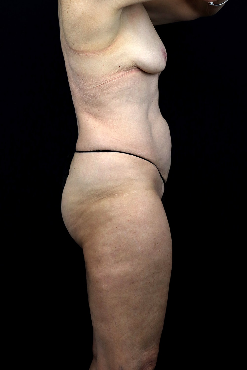 Fat Transfer To Breasts Before & After