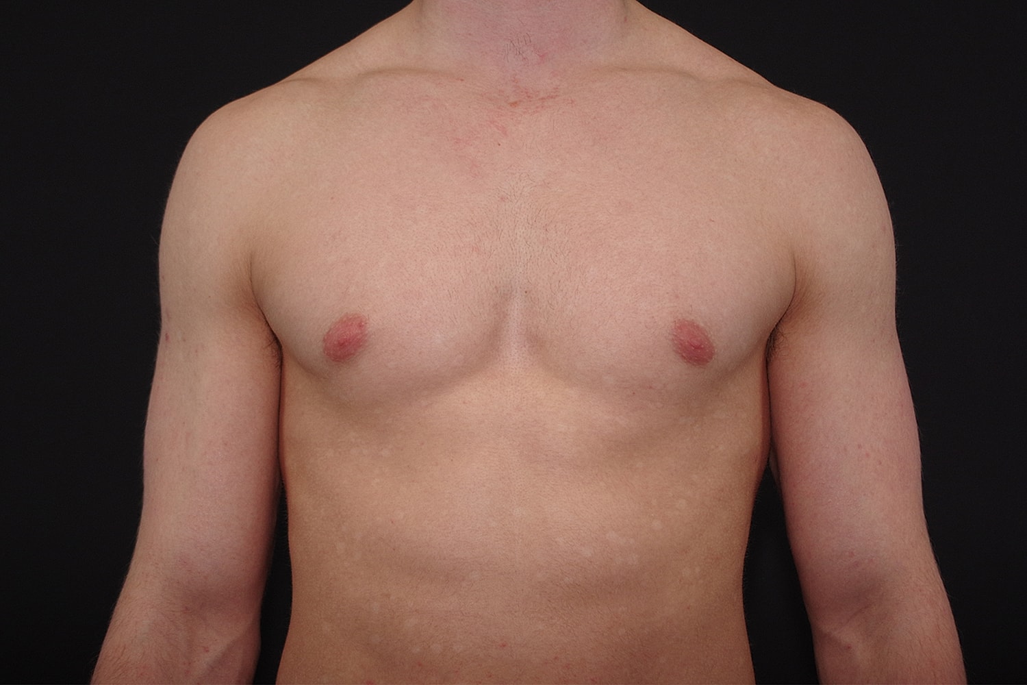 Gynecomastia Before & After