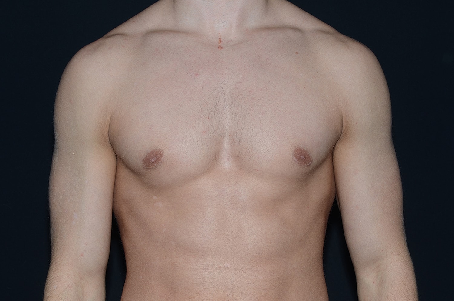 Gynecomastia Before & After