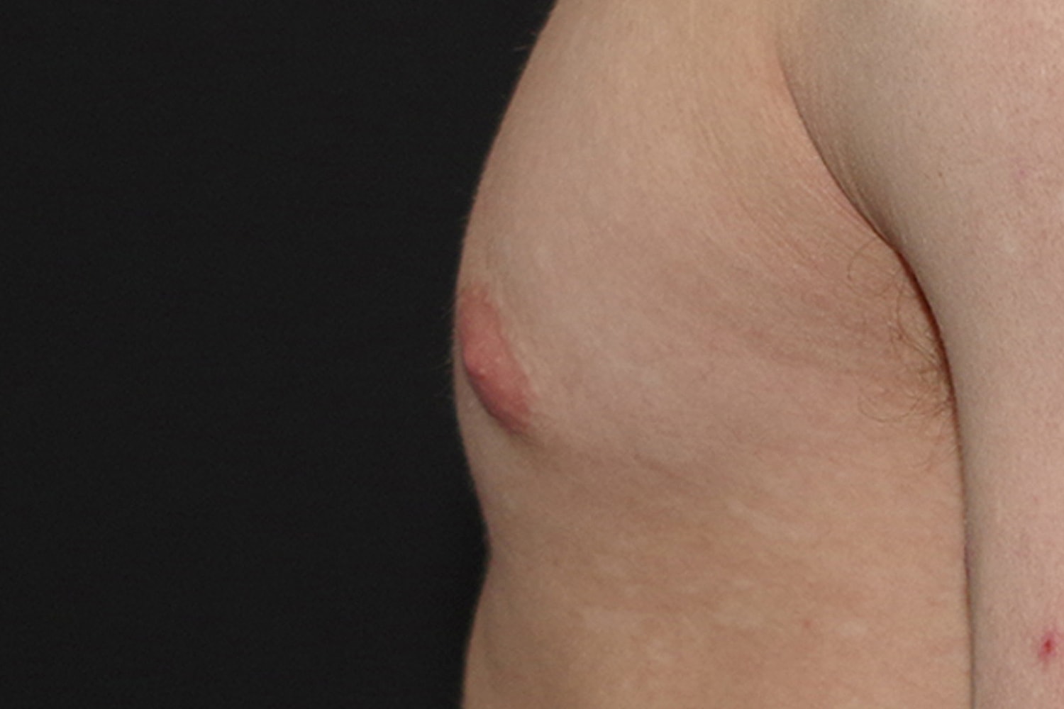 Gynecomastia Before & After