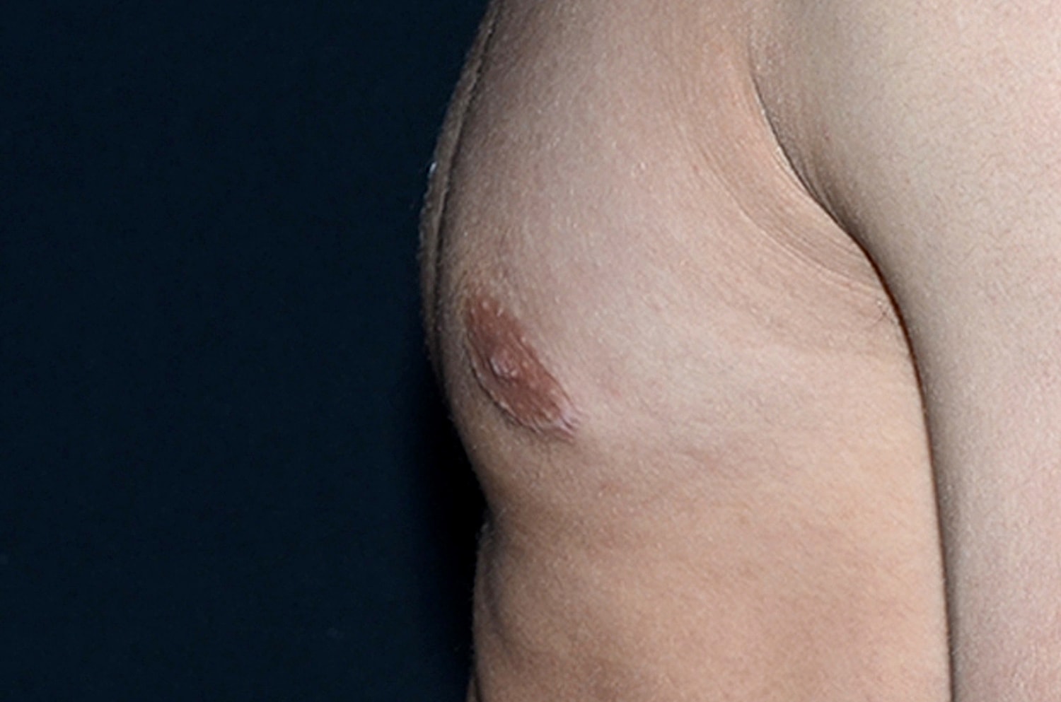 Gynecomastia Before & After