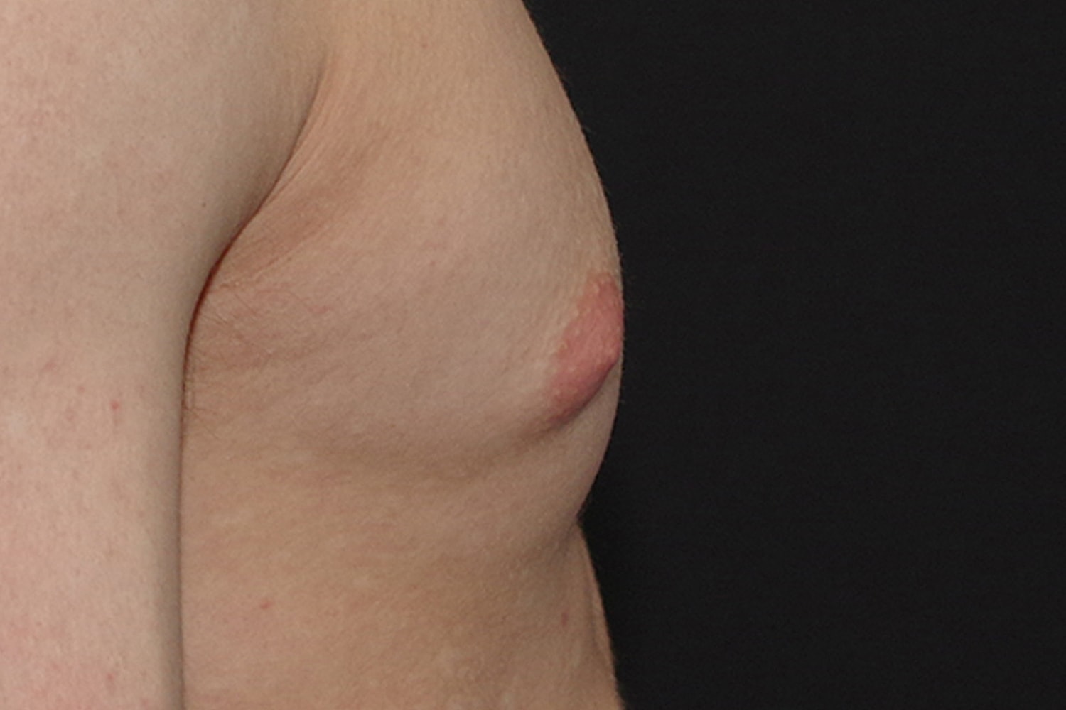 Gynecomastia Before & After