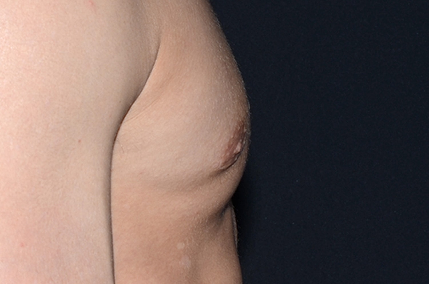 Gynecomastia Before & After