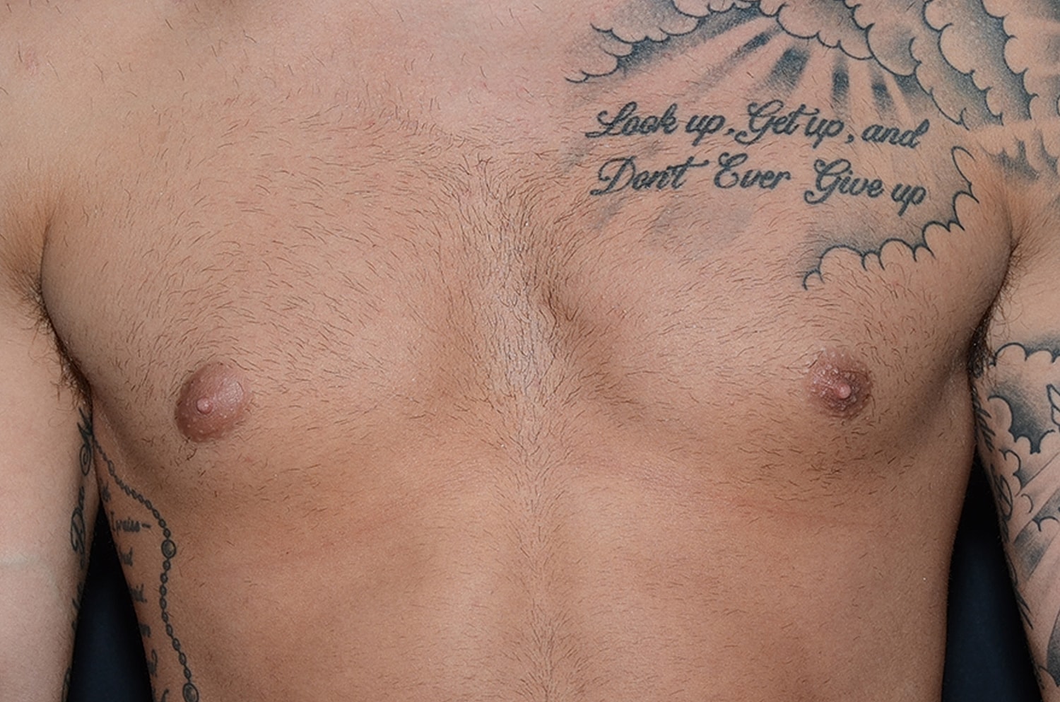 Gynecomastia Before & After