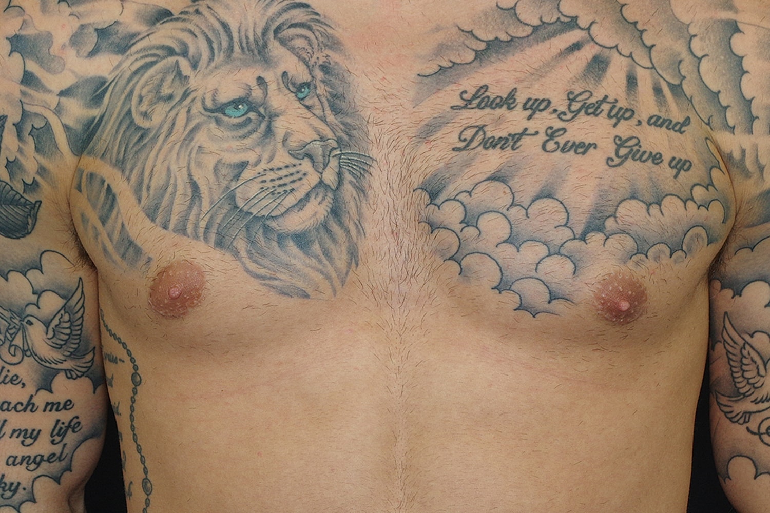 Gynecomastia Before & After
